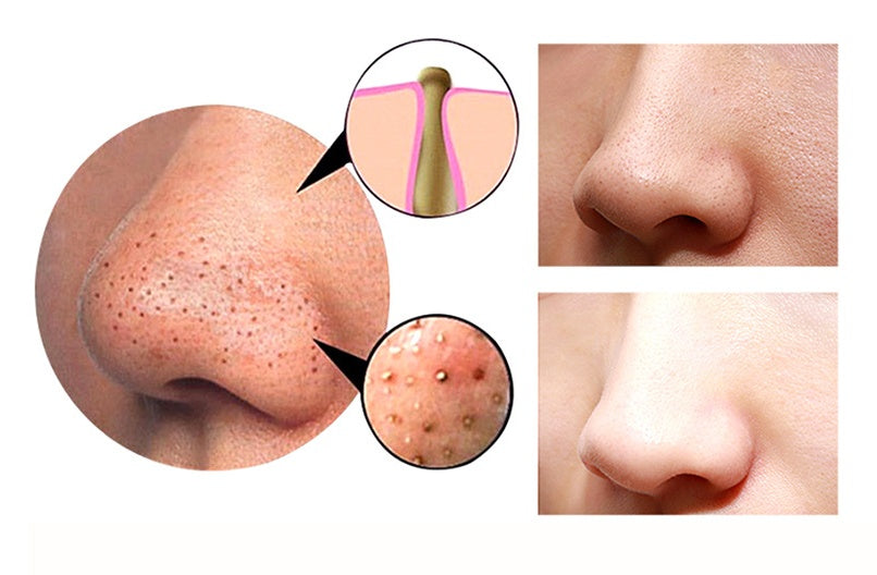4 in 1 Body Guasha Cupping Blackhead Remover Machine Facial Pore Deep Cleansing Beauty Skin Care-17680e93b227fbeb9b074f72b5e3e5a8