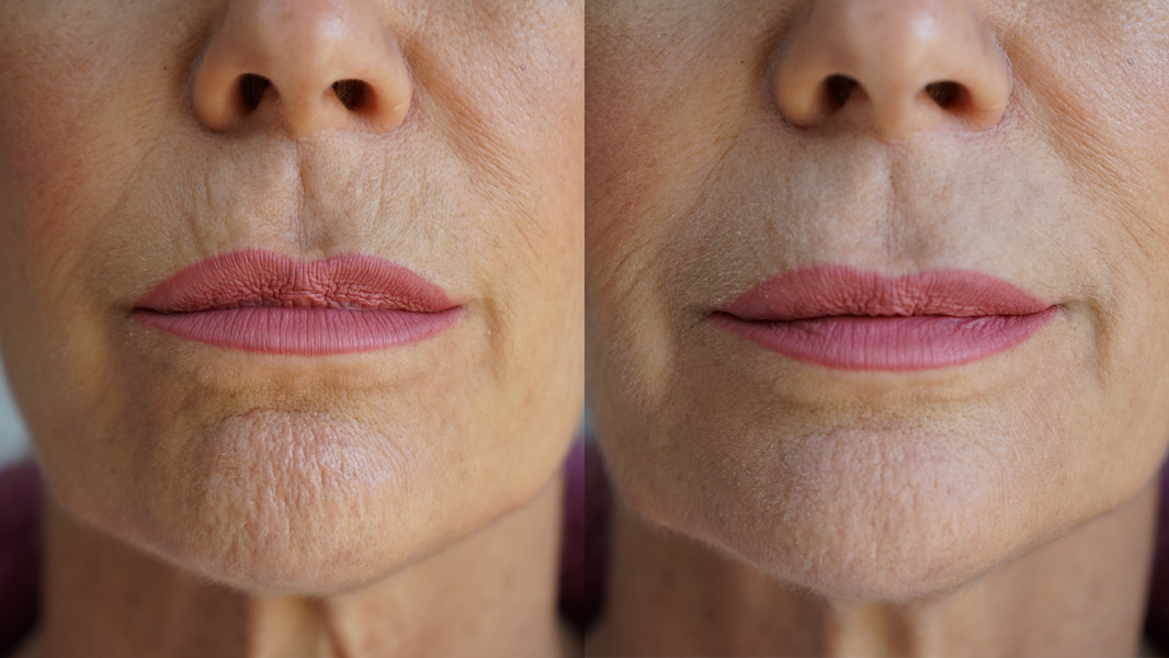 Ageless Lip & Line Filler-Ageless Lip & Line Filler