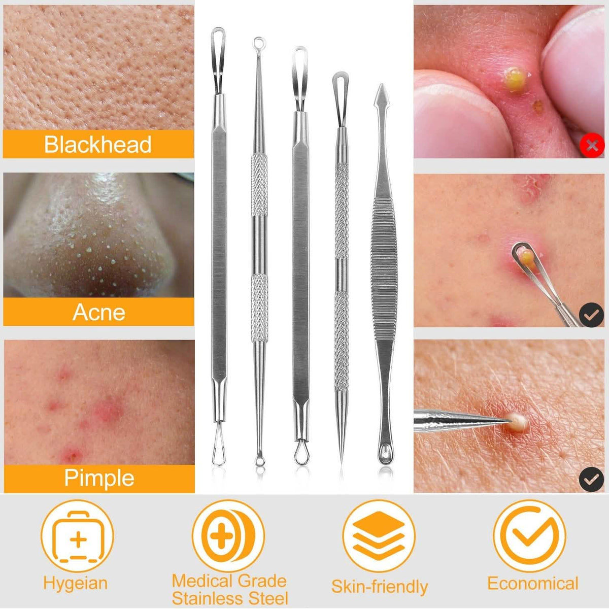 5-Piece Set: Blackhead Remover Kit Stainless Steel Popping Zit Remover-5-Piece Set: Blackhead Remover Kit Stainless Steel Popping Zit Remover