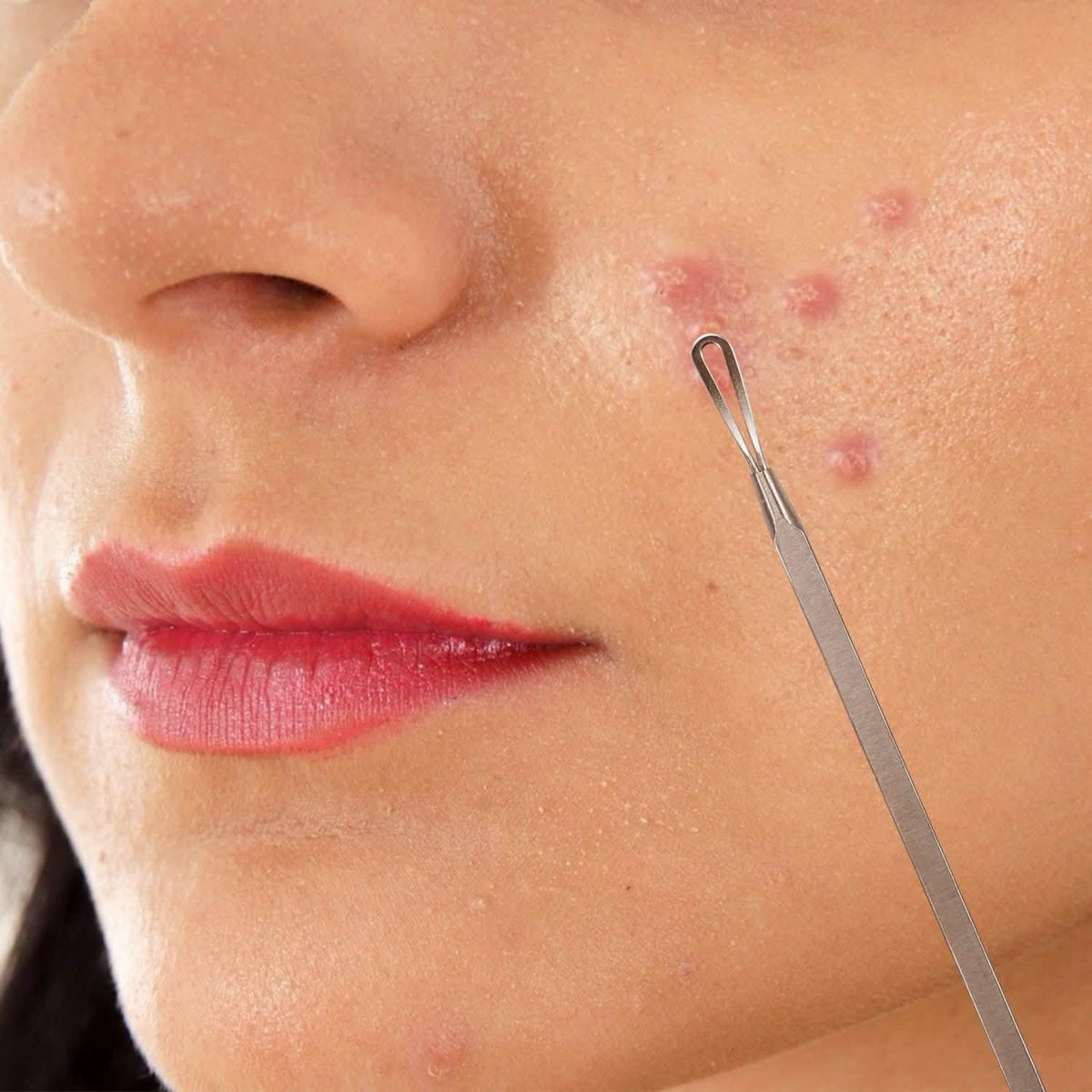 7-Pieces: Blackhead Remover Stainless Steel-7-Pieces: Blackhead Remover Stainless Steel