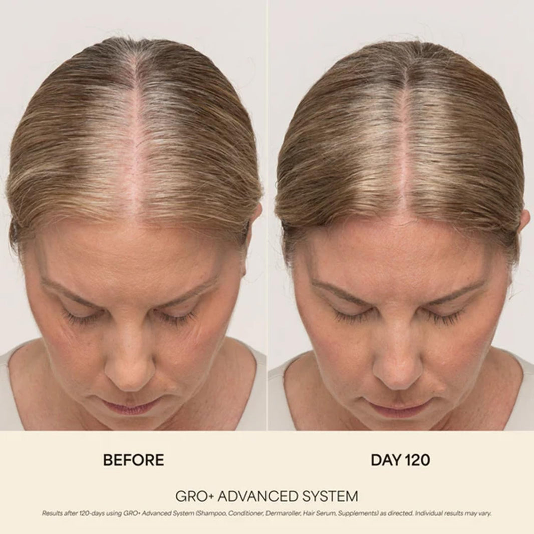 VEGAMOUR GRO+ Advanced Hair Serum | Improves Hair Density, Reduces Shedding and Promotes a Balanced Scalp | For Severe Signs of Thinning | Formulated Without Fragrance, Vegan, Cruelty-Free-VEGAMOUR GRO+ Advanced Hair Serum | Improves Hair Density, Reduces Shedding and Promotes a Balanced Scalp | For Severe Signs of Thinning | Formulated Without Fragrance, Vegan, Cruelty-Free