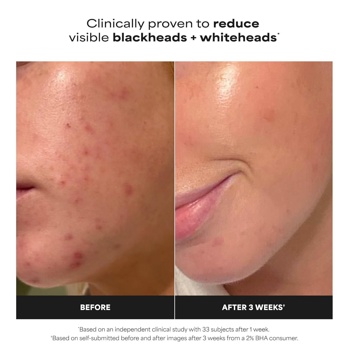 Paula's Choice SKIN PERFECTING 2% BHA Liquid Exfoliant with Salicylic Acid, Facial Polish for Pores, Wrinkles & Fine Lines, Suitable for Blackhead-Prone Skin, Fragrance-Free-Paula's Choice SKIN PERFECTING 2% BHA Liquid Exfoliant with Salicylic Acid, Facial Polish for Pores, Wrinkles & Fine Lines, Suitable for Blackhead-Prone Skin, Fragrance-Free
