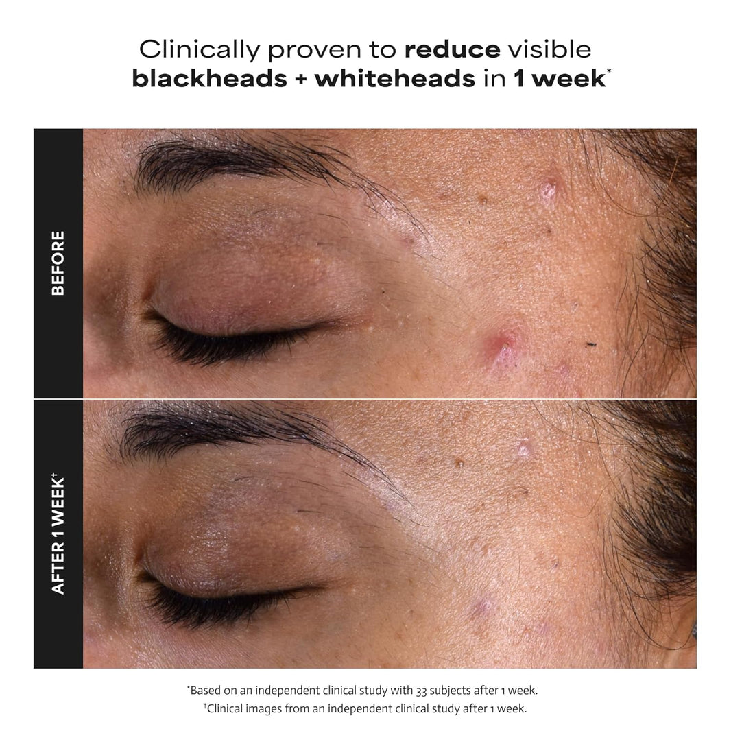 Paula's Choice SKIN PERFECTING 2% BHA Liquid Exfoliant with Salicylic Acid, Facial Polish for Pores, Wrinkles & Fine Lines, Suitable for Blackhead-Prone Skin, Fragrance-Free-Paula's Choice SKIN PERFECTING 2% BHA Liquid Exfoliant with Salicylic Acid, Facial Polish for Pores, Wrinkles & Fine Lines, Suitable for Blackhead-Prone Skin, Fragrance-Free