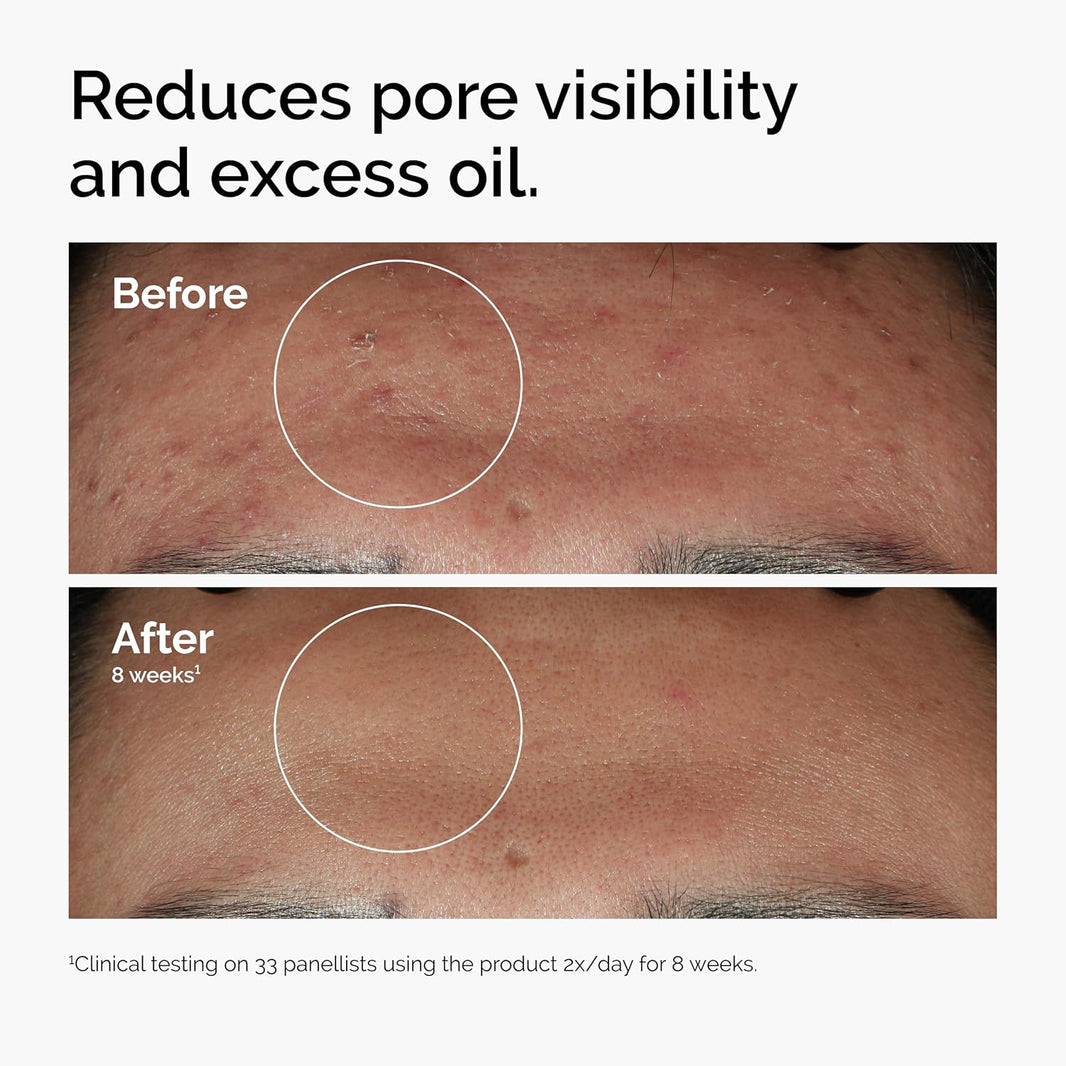 The Ordinary Niacinamide 10% + Zinc 1%, Smoothing Serum for Blemish-Prone Skin-The Ordinary Niacinamide 10% + Zinc 1%, Smoothing Serum for Blemish-Prone Skin