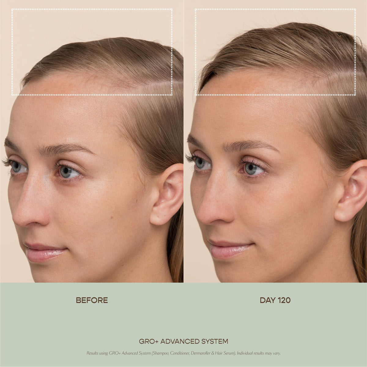 VEGAMOUR GRO+ Advanced Hair Serum | Improves Hair Density, Reduces Shedding and Promotes a Balanced Scalp | For Severe Signs of Thinning | Formulated Without Fragrance, Vegan, Cruelty-Free-VEGAMOUR GRO+ Advanced Hair Serum | Improves Hair Density, Reduces Shedding and Promotes a Balanced Scalp | For Severe Signs of Thinning | Formulated Without Fragrance, Vegan, Cruelty-Free