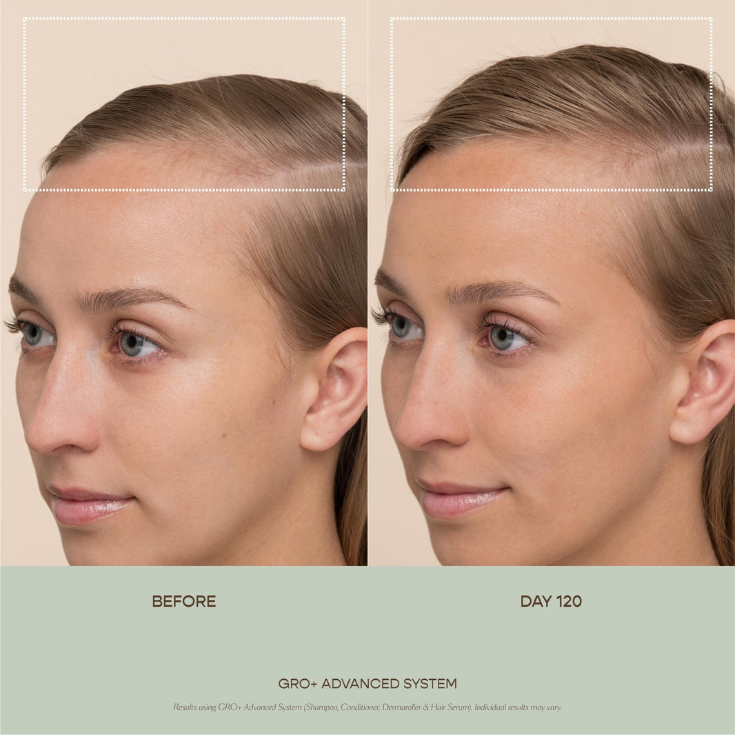 VEGAMOUR GRO+ Advanced Hair Serum | Improves Hair Density, Reduces Shedding and Promotes a Balanced Scalp | For Severe Signs of Thinning | Formulated Without Fragrance, Vegan, Cruelty-Free-VEGAMOUR GRO+ Advanced Hair Serum | Improves Hair Density, Reduces Shedding and Promotes a Balanced Scalp | For Severe Signs of Thinning | Formulated Without Fragrance, Vegan, Cruelty-Free