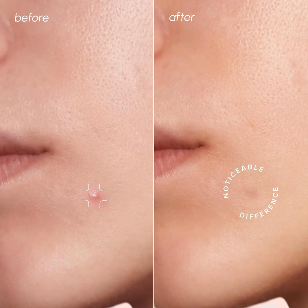 Invisible Pimple & Acne Patches-Invisible Pimple & Acne Patches