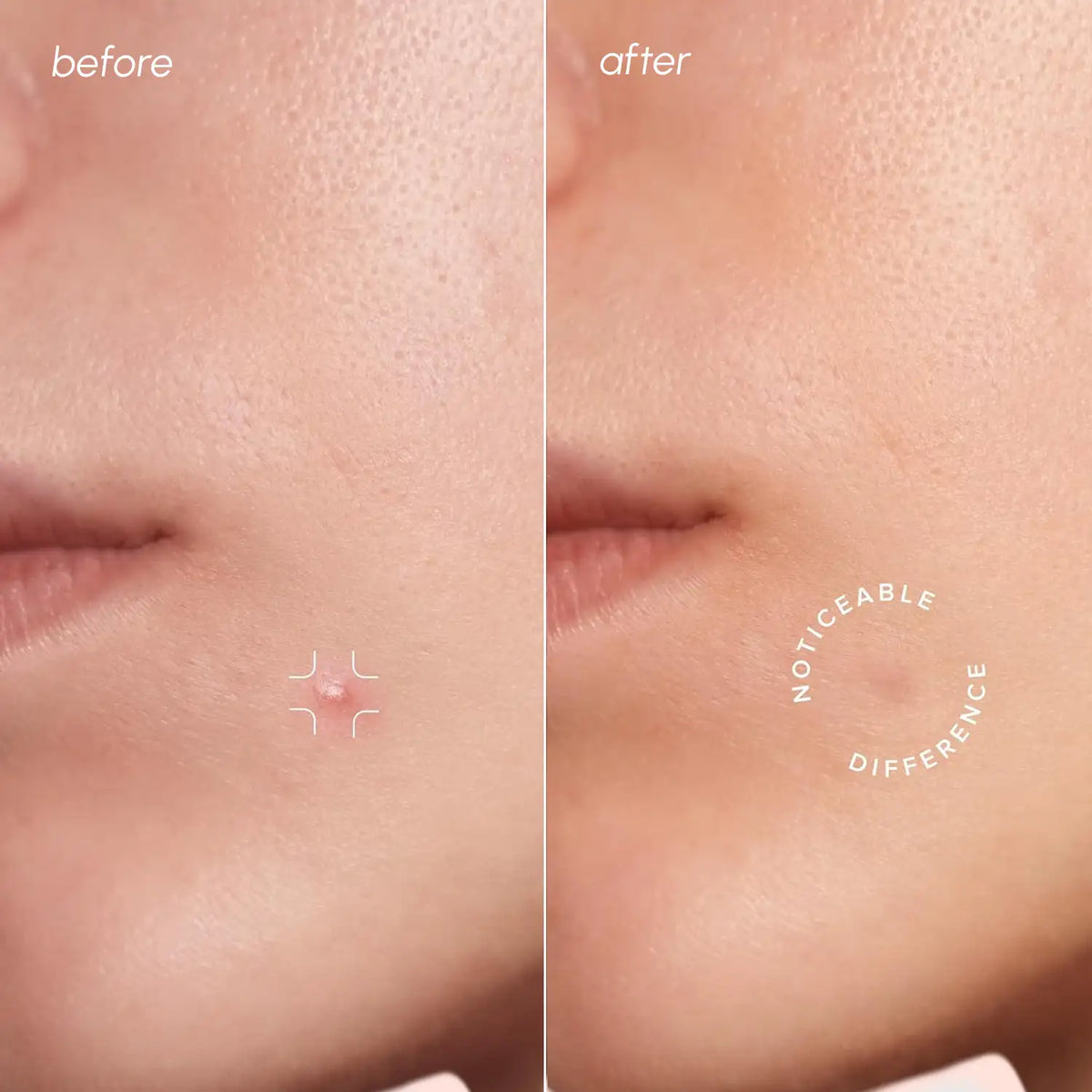 Invisible Pimple & Acne Patches-Invisible Pimple & Acne Patches