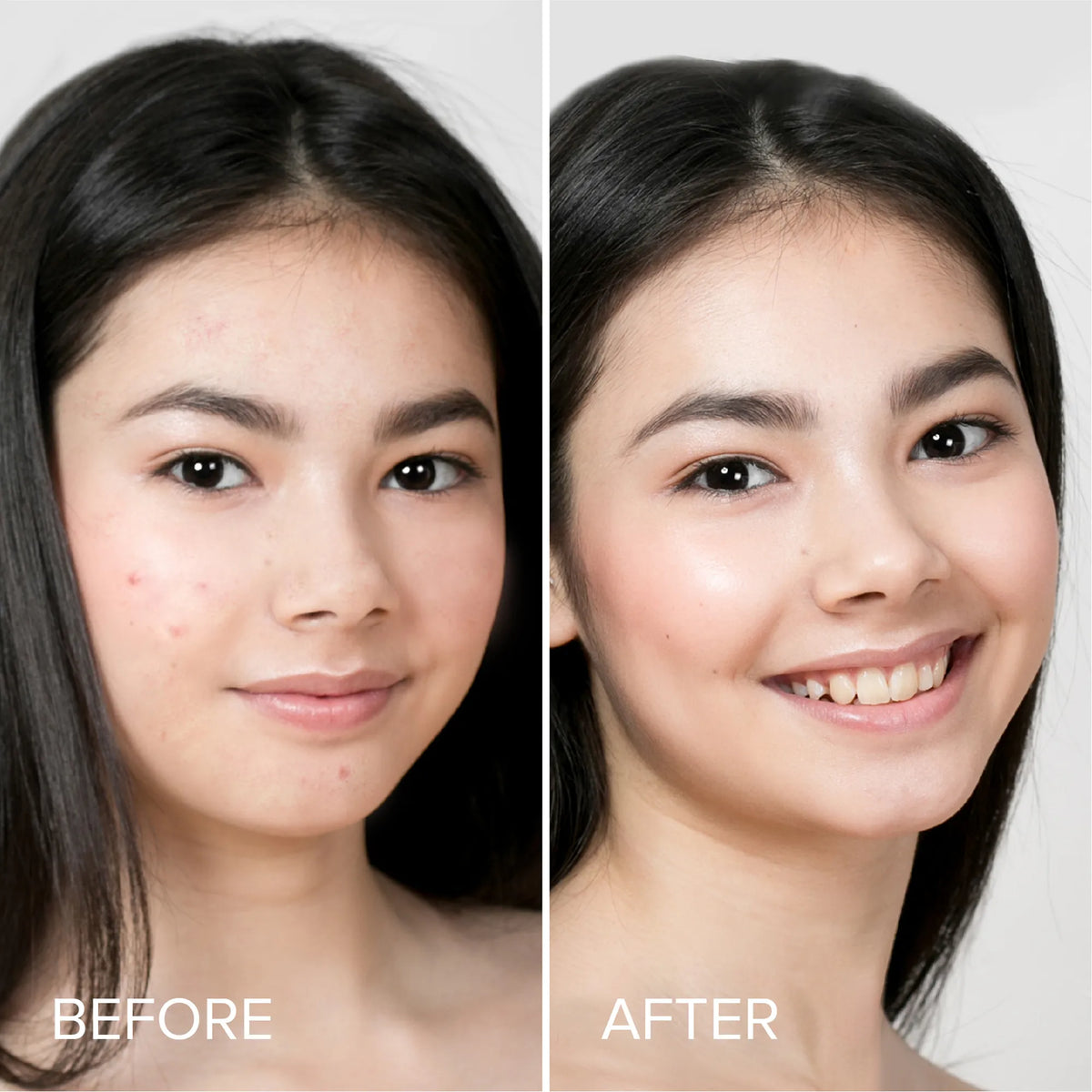 Pimple & Acne Patches-Pimple & Acne Patches