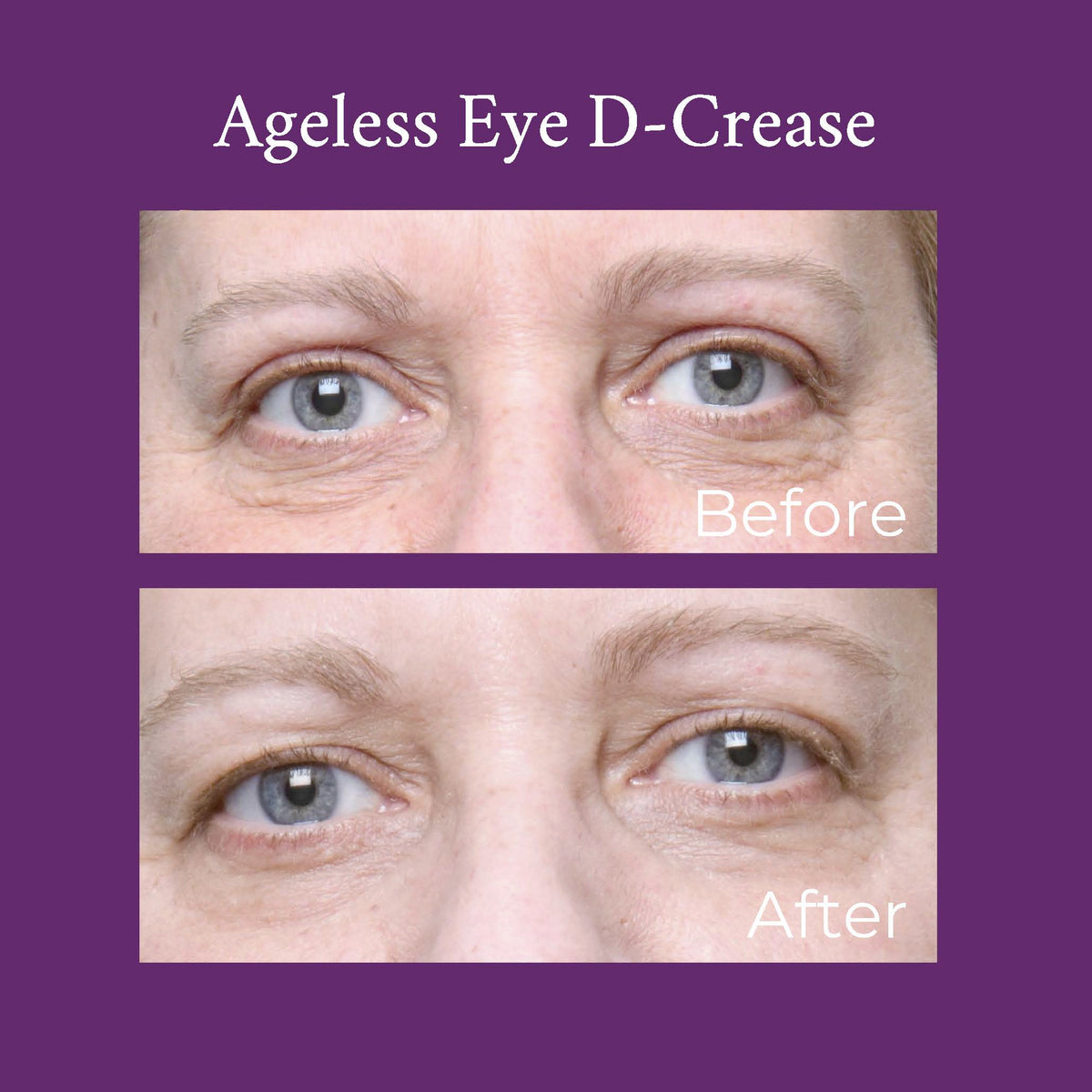 Ageless Eye D-Crease-Ageless Eye D-Crease