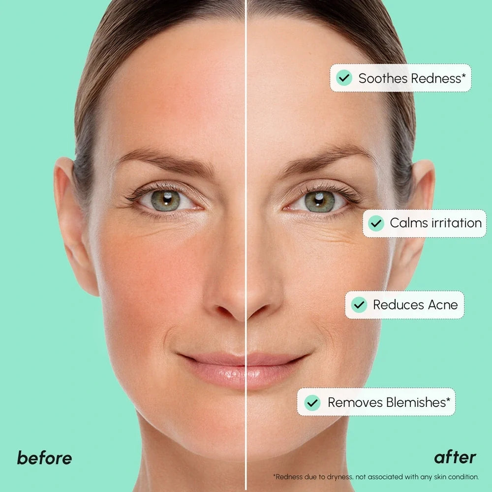 Redness Soothing Azelaic Acid Serum-Redness Soothing Azelaic Acid Serum