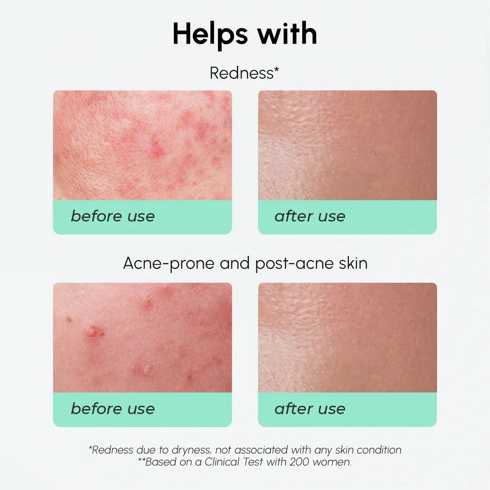 Redness Soothing Azelaic Acid Serum-Redness Soothing Azelaic Acid Serum