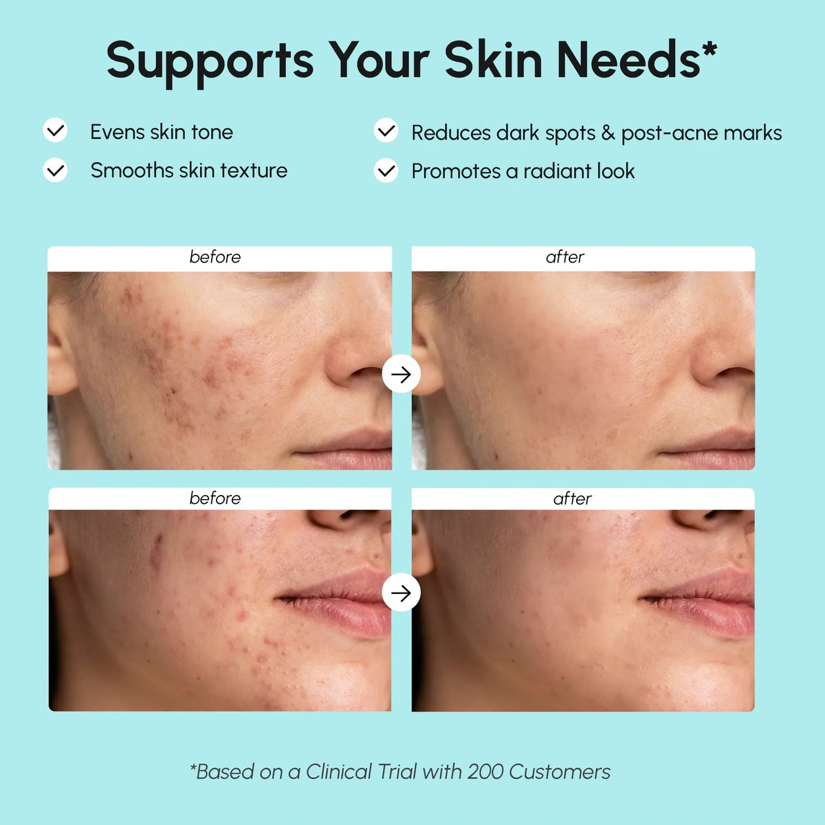 Azelaic Acid Cream for Sensitive Skin-Azelaic Acid Cream for Sensitive Skin