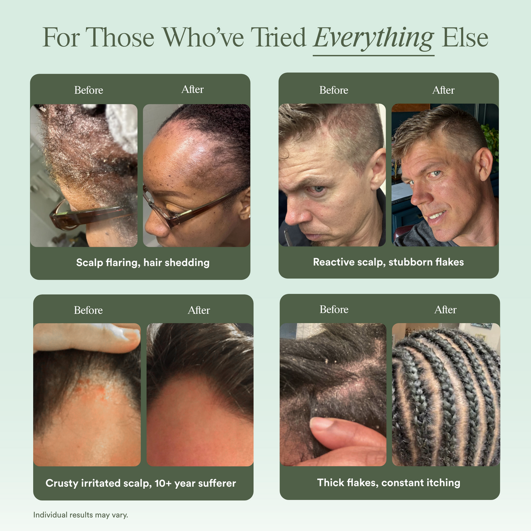 Scalp Relief System-Scalp Relief System