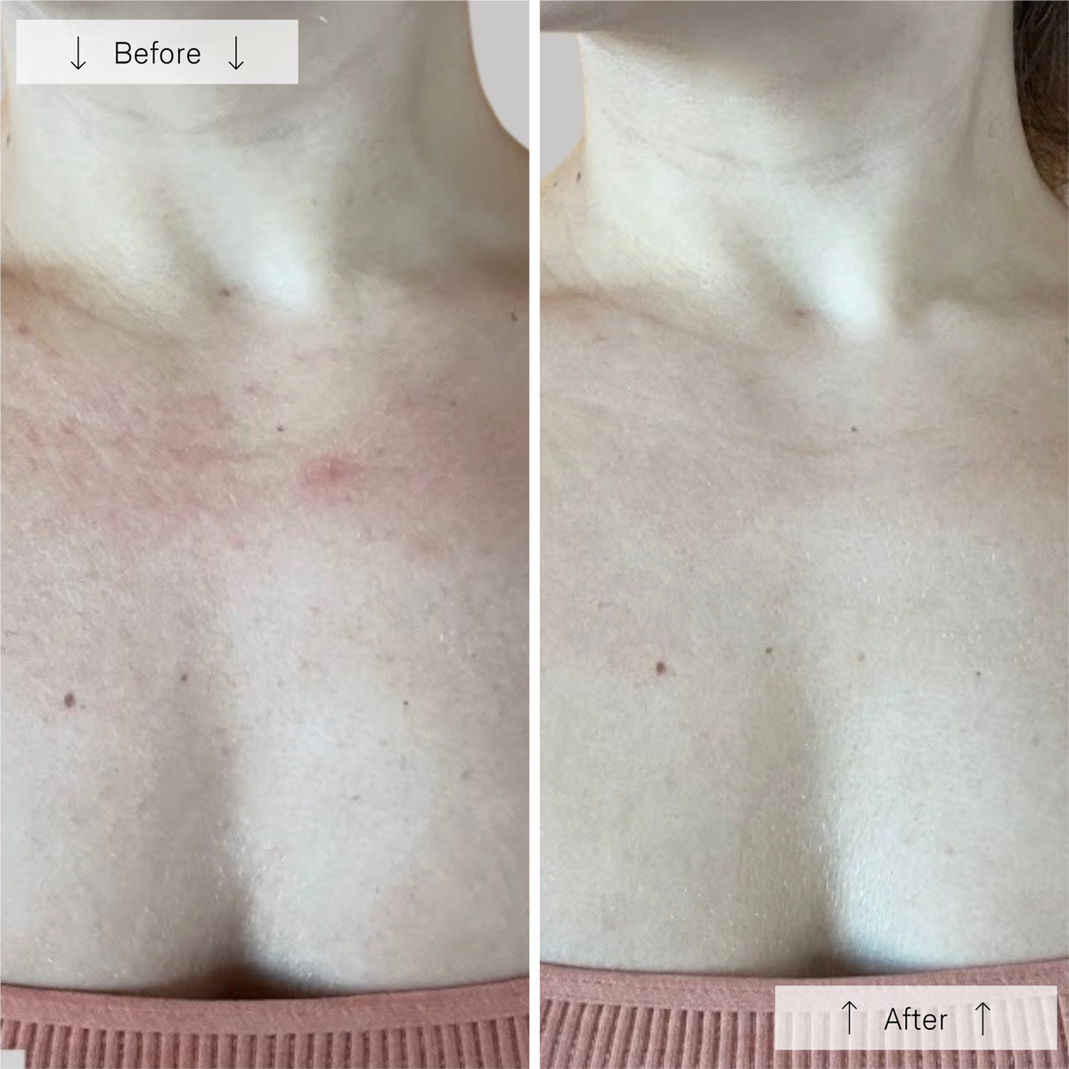 Omnilux Contour Neck & Décolleté-Omnilux Contour Neck & Décolleté