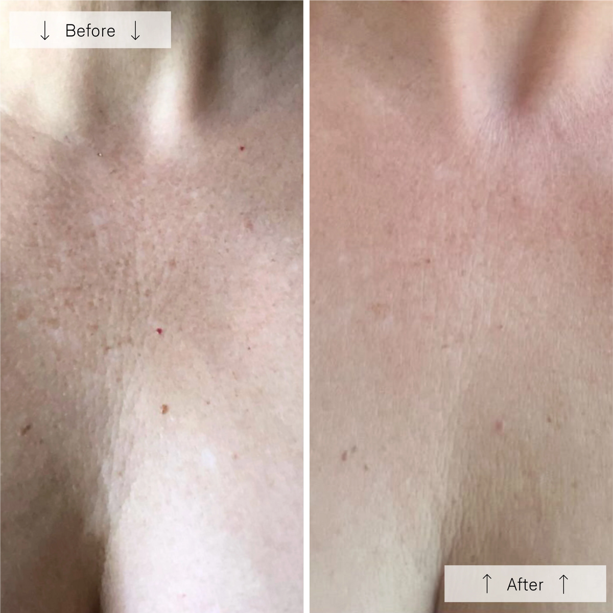 Omnilux Contour Neck & Décolleté-Omnilux Contour Neck & Décolleté