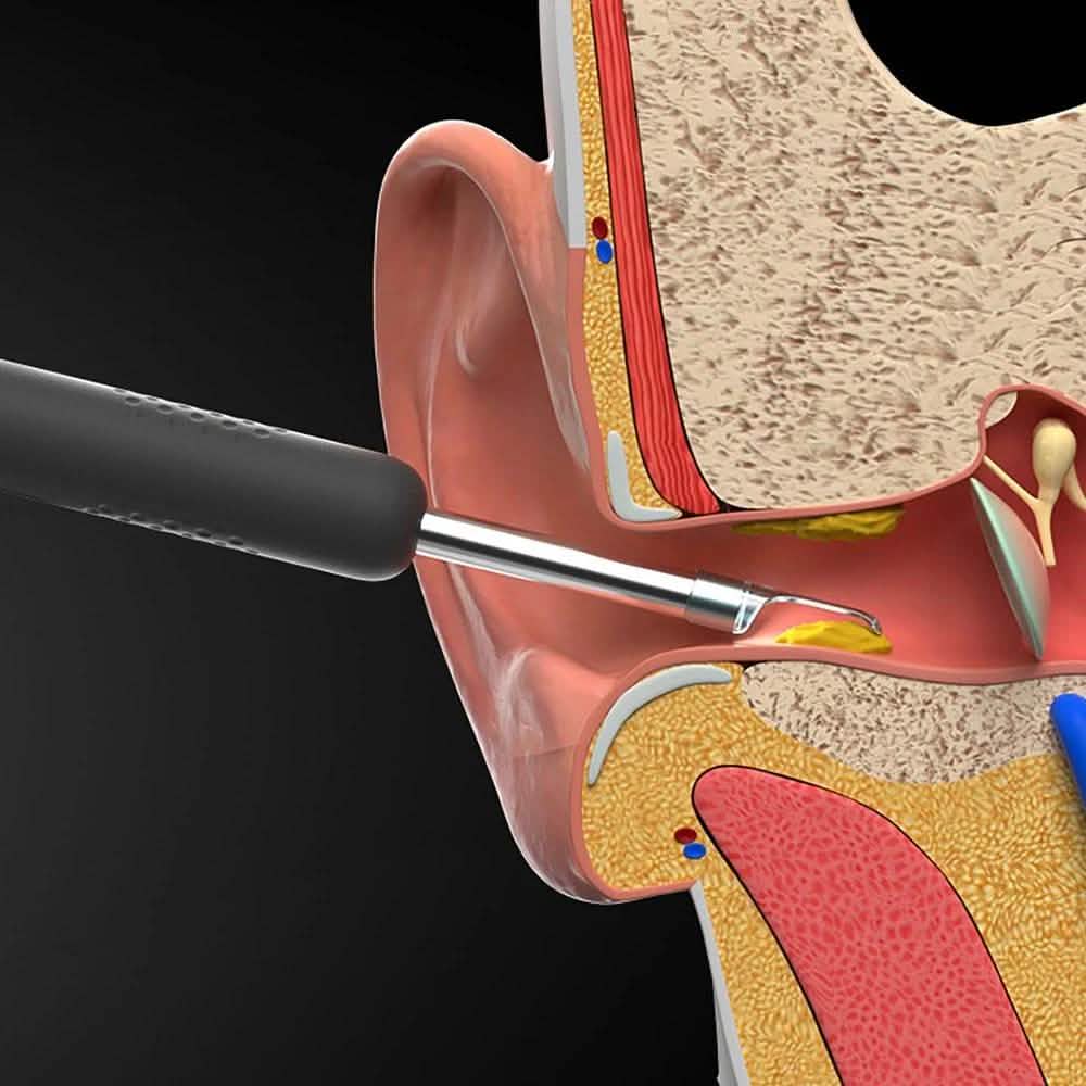 Bebird R1 Wireless Intelligent Visual Otoscope Ear Cleaner-Bebird R1 Wireless Intelligent Visual Otoscope Ear Cleaner
