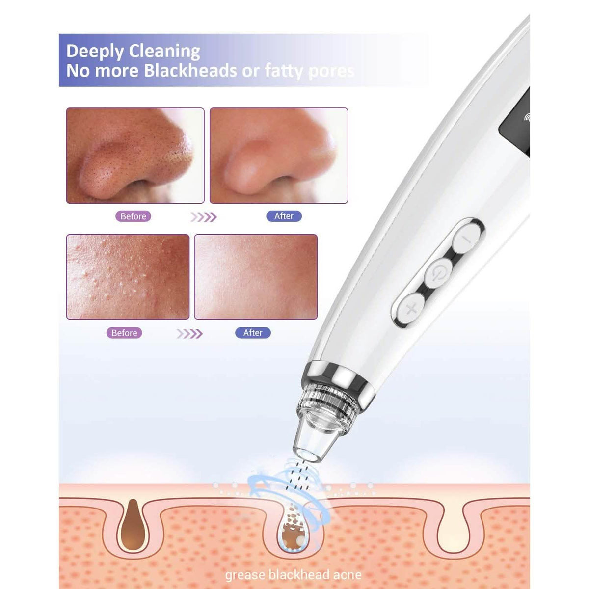 Blackhead Pore Vacuum Cleaner Remover-Blackhead Pore Vacuum Cleaner Remover