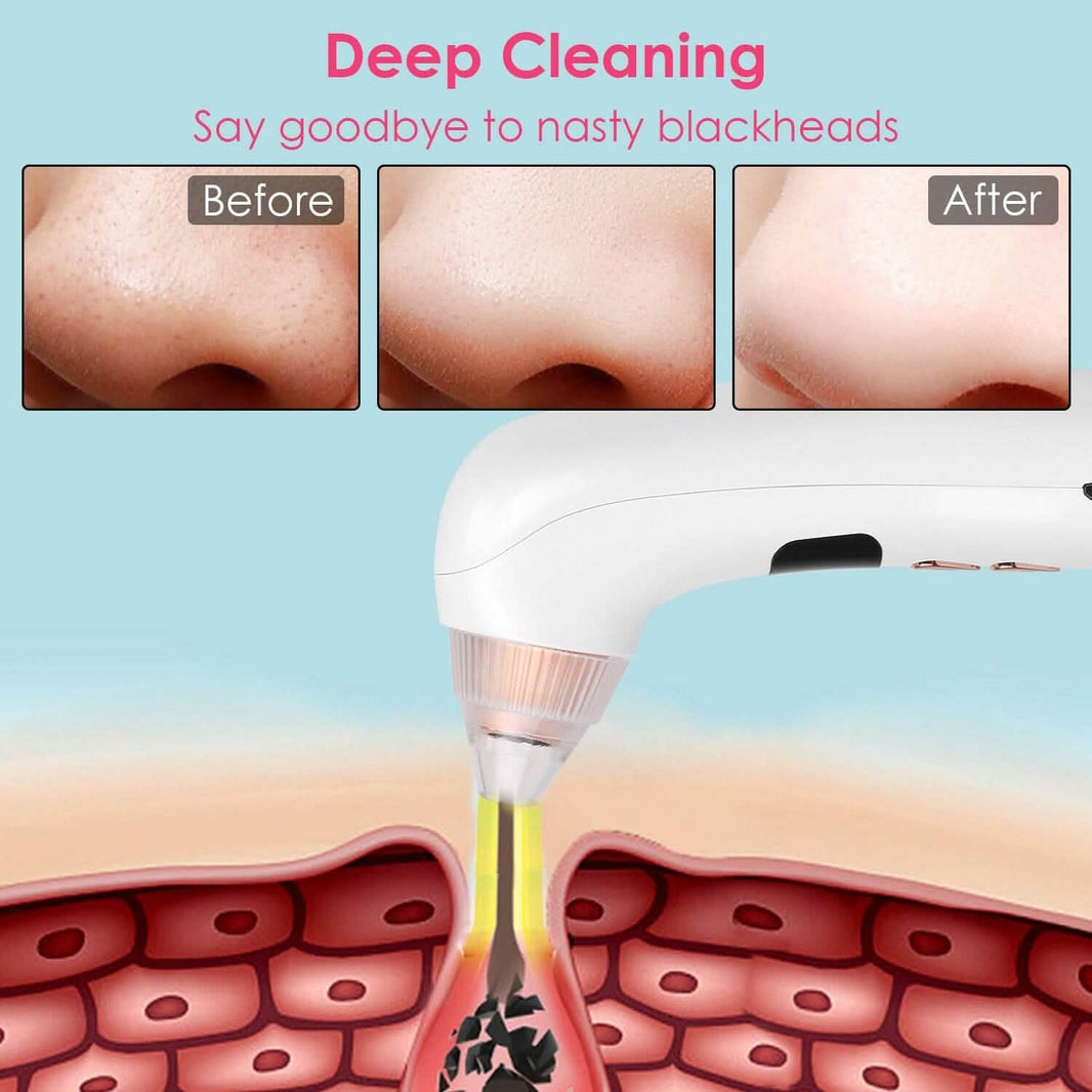 Blackhead Vacuum Remover Electric Blackhead Comedone Extractor-Blackhead Vacuum Remover Electric Blackhead Comedone Extractor