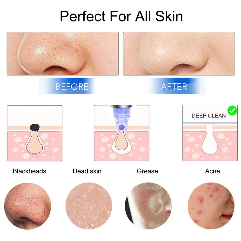 Rejuvenate Your Skin - Blackhead Remover Vacuum - Facial Pore Vacuum Extractor Electric Pore Cleaner-Rejuvenate Your Skin - Blackhead Remover Vacuum - Facial Pore Vacuum Extractor Electric Pore Cleaner