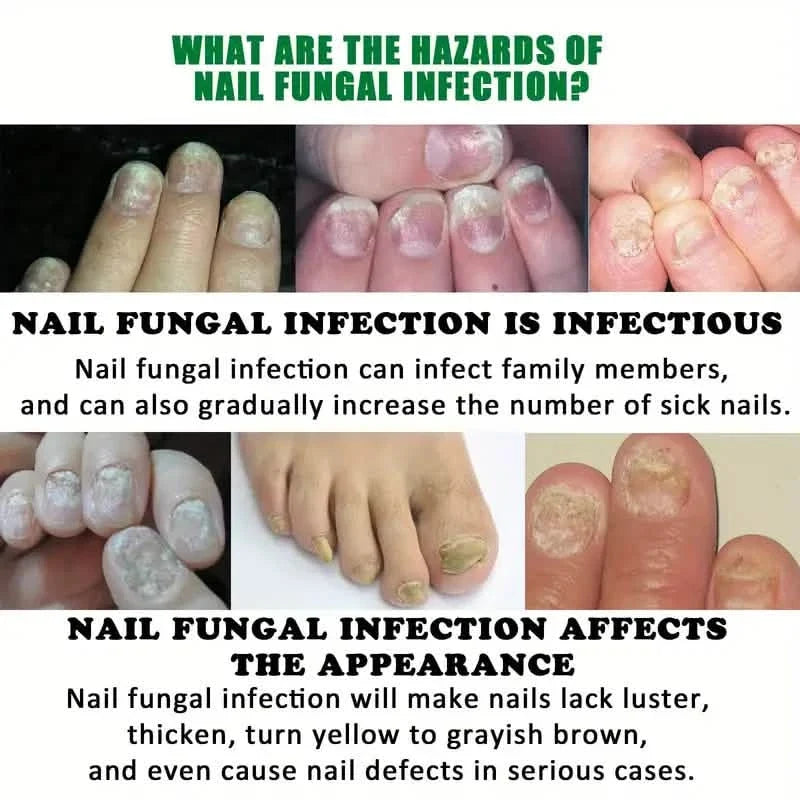 Ginger Nail Care Liquid Onychomycosis Fungus Repair Hand and Foot Nail Care-Ginger Nail Care Liquid Onychomycosis Fungus Repair Hand and Foot Nail Care