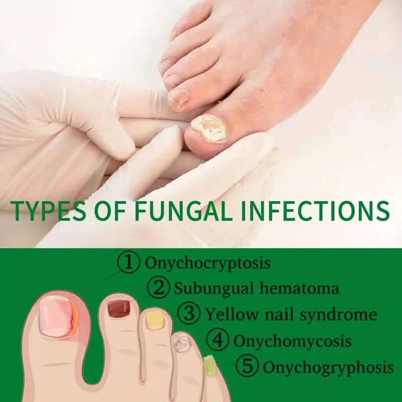 Ginger Nail Care Liquid Onychomycosis Fungus Repair Hand and Foot Nail Care-Ginger Nail Care Liquid Onychomycosis Fungus Repair Hand and Foot Nail Care