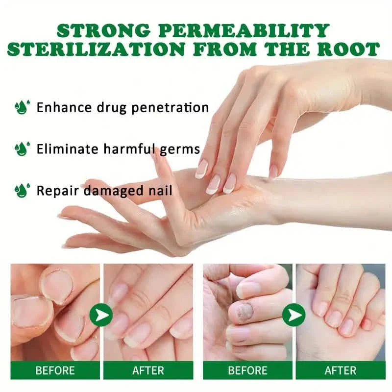 Ginger Nail Care Liquid Onychomycosis Fungus Repair Hand and Foot Nail Care-Ginger Nail Care Liquid Onychomycosis Fungus Repair Hand and Foot Nail Care