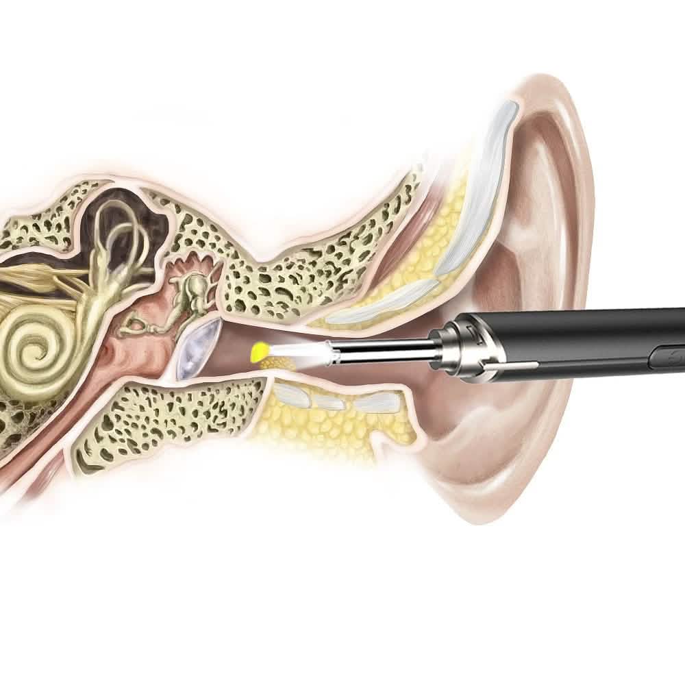 Intelligent Visual Ear Otoscope Inspection Tool-Intelligent Visual Ear Otoscope Inspection Tool
