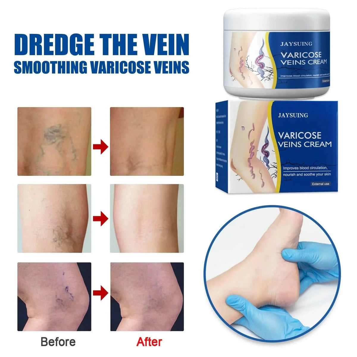 Pain Relief Leg Spider Veins Vasculitis Promote Circulation Smooth Metabolism 30g Exfoliation-Pain Relief Leg Spider Veins Vasculitis Promote Circulation Smooth Metabolism 30g Exfoliation