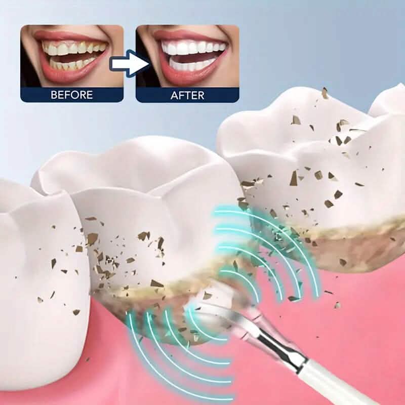 ProClean Electric Teeth Whitening Tool Set-ProClean Electric Teeth Whitening Tool Set
