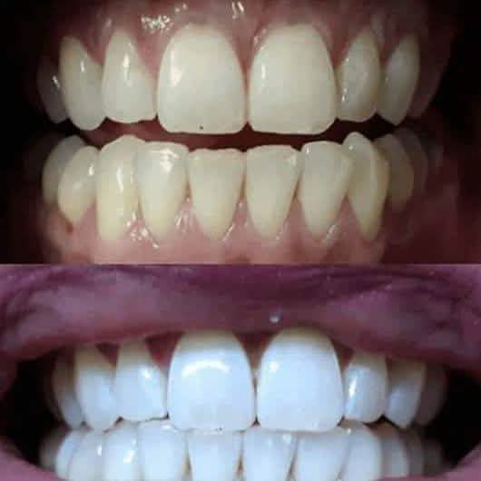 TrueWhite Advanced Plus 2 Person Whitening System-TrueWhite Advanced Plus 2 Person Whitening System