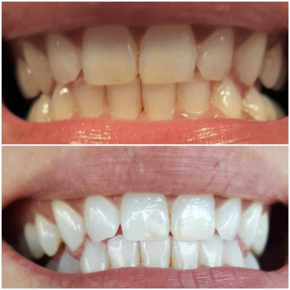 TrueWhite Advanced Plus 2 Person Whitening System-TrueWhite Advanced Plus 2 Person Whitening System